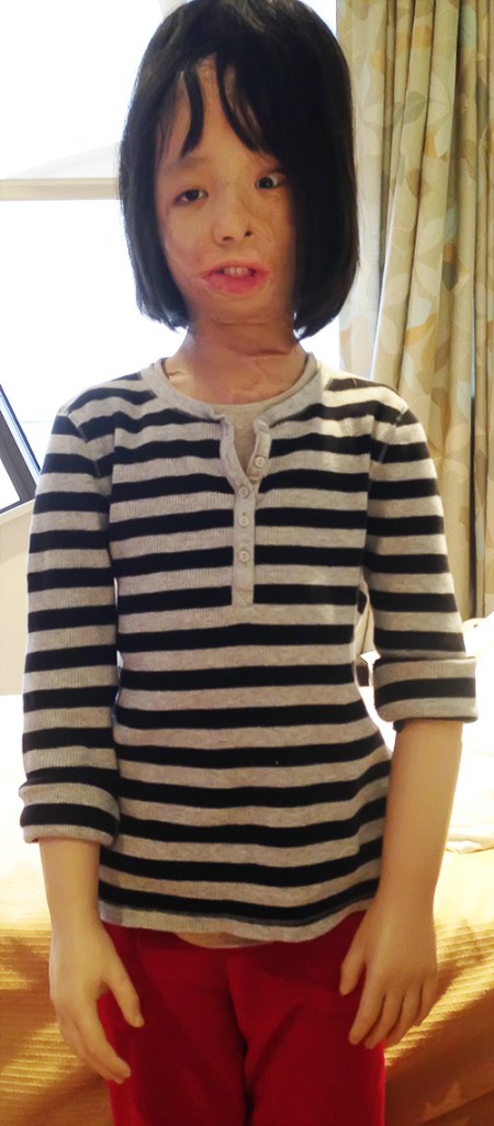 Boun Lod with Her New Arms